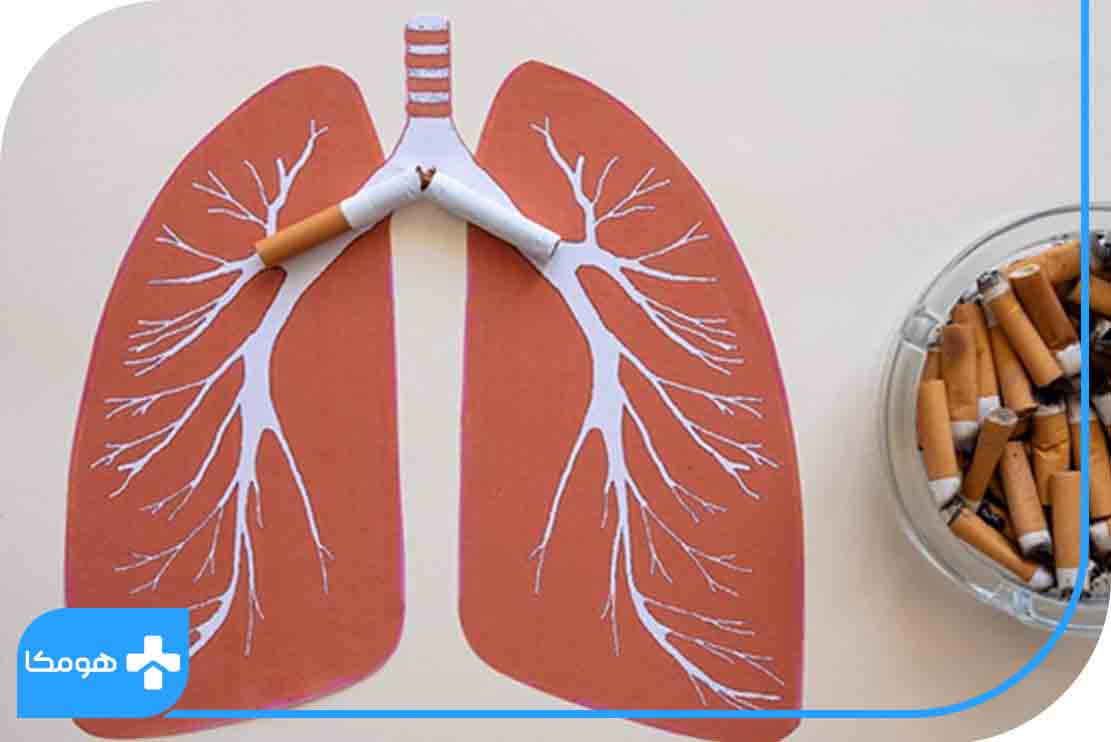 درمان سرطان ریه + آيا سرطان ريه درمان دارد؟ | مجله هومکا